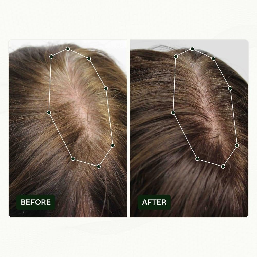 Routine di crescita dei capelli per donne di Scandinavian Biolabs con risultati clinicamente provati in 45 giorni | Trattamento contro la caduta dei capelli (Bio-Pilixin) Naty Shop Hair Care