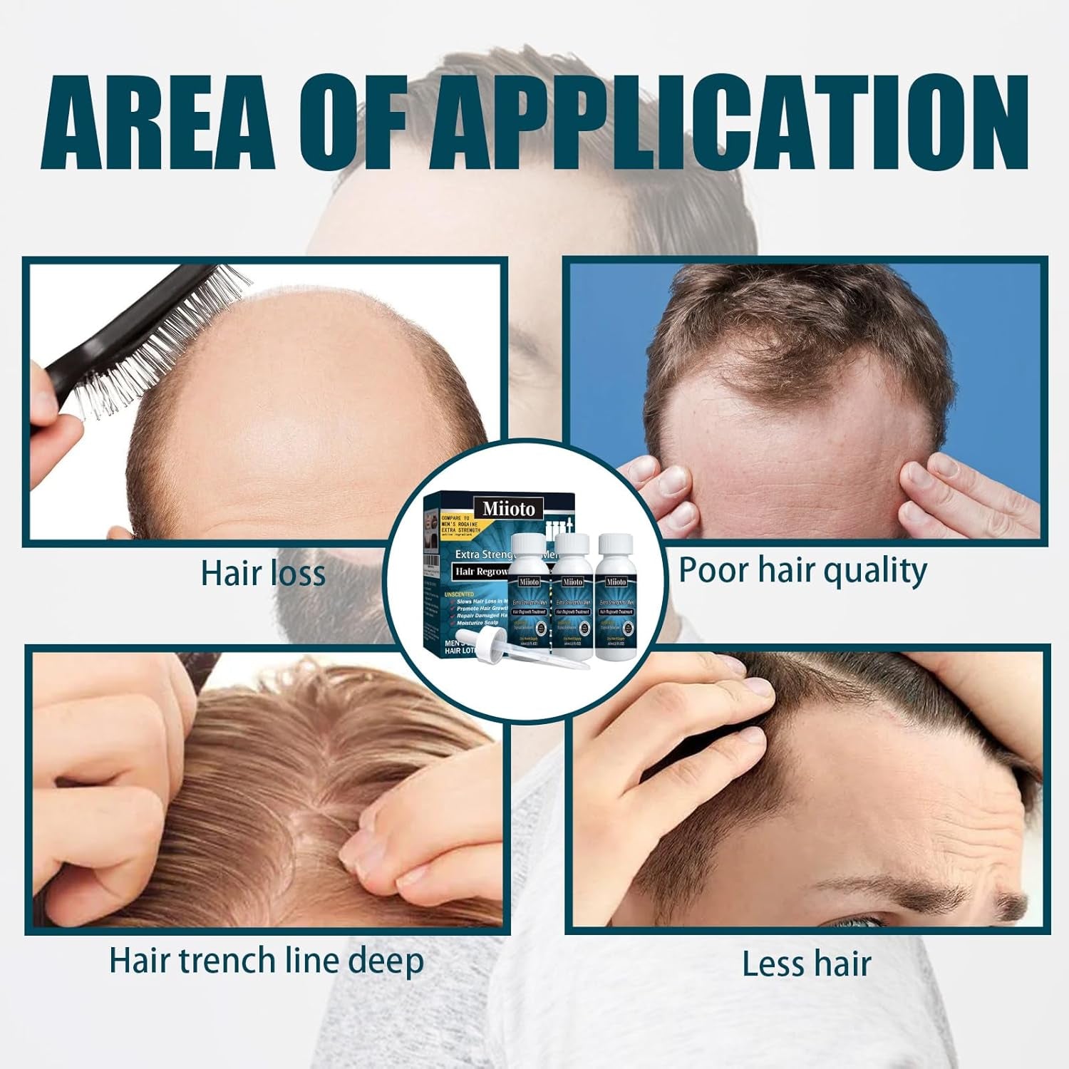 Miioto Siero per la crescita dei capelli Prodotto per la crescita dei capelli da uomo Crescita dei capelli Siero per capelli Cura del cuoio capelluto Promuovere capelli più spessi Nutrire il cuoio capelluto Prevenire la perdita dei capelli 3*60ML Cura dei capelli Naty Shop